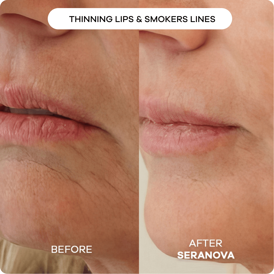 The Microneedling Infusion System™ 1 Month | 2 Treatments