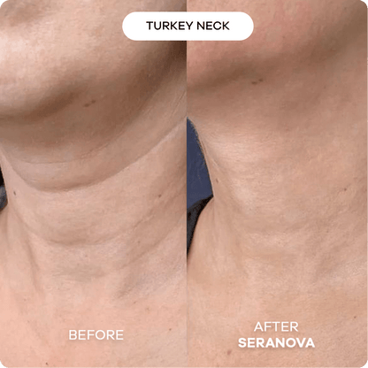 The Microneedling Infusion System™ 1 Month | 2 Treatments