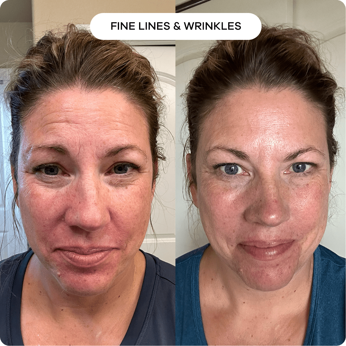 The Microneedling Infusion System™ 1 Month | 2 Treatments