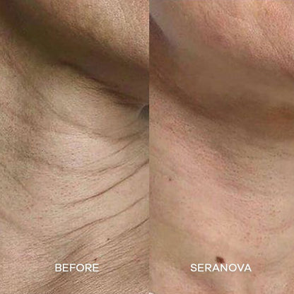 The Microneedling Infusion System™ 1 Month | 2 Treatments